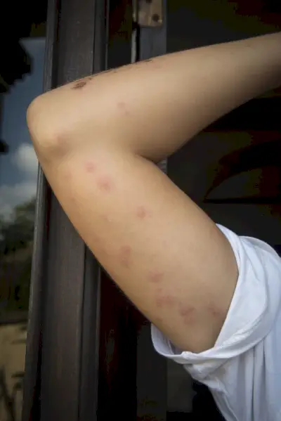 bed bug bite